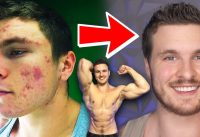 How To AVOID ACNE While Working Out & Gaining Muscle!