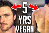 Veganism Does NOT Clear Acne (IT MAKES IT WORSE!)