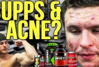 WHICH BODYBUILDING SUPPLEMENTS CAUSE ACNE? | Creatine, Protein, Etc.